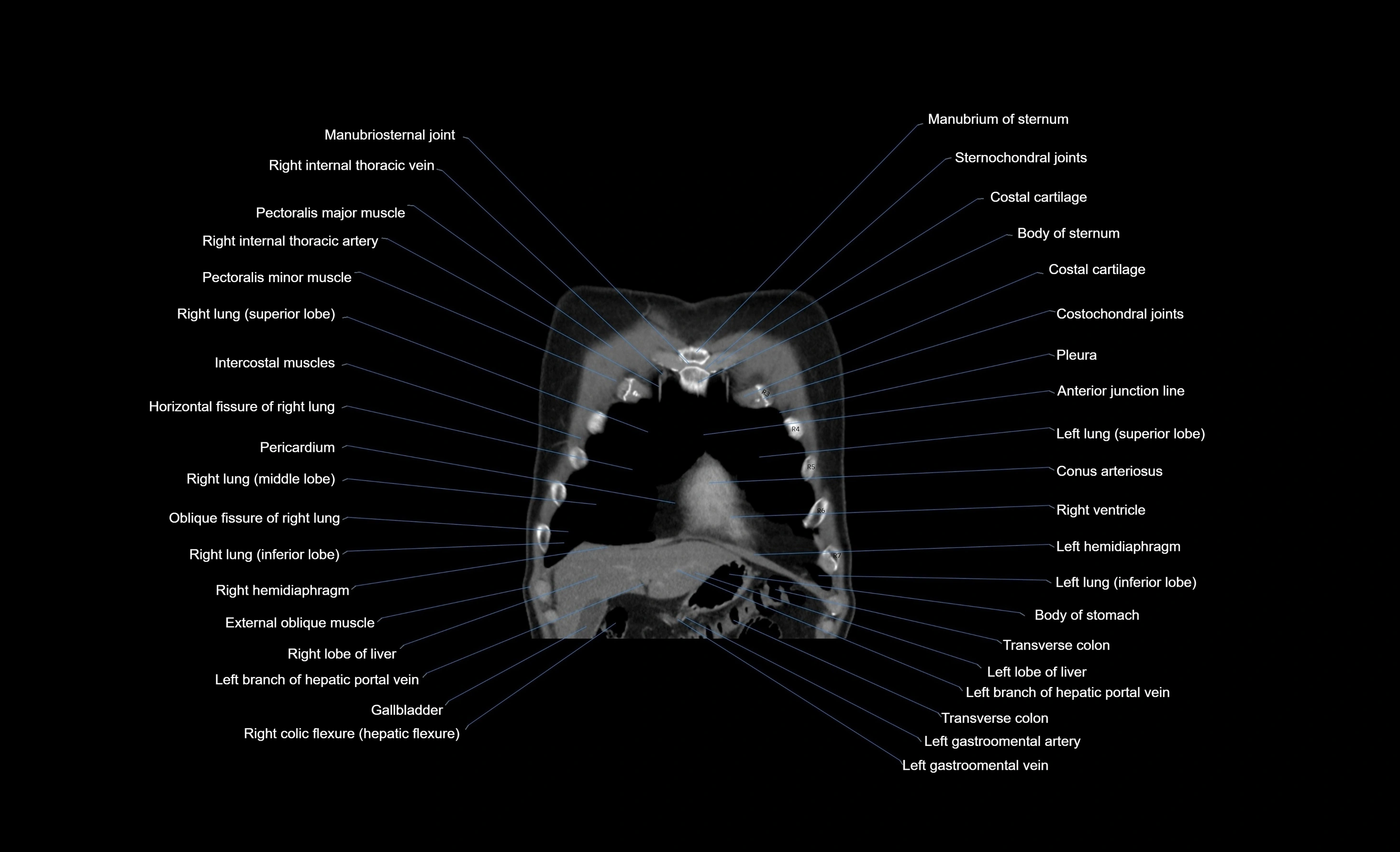 CT chest (thorax) labelled coronal cross sectional anatomy radiology image-00095.webp